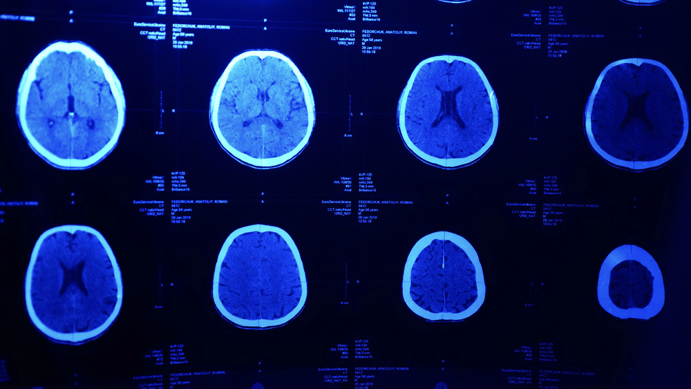 Image showing brain scans on a blue board.